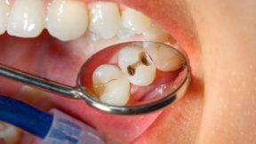 Tooth Cavity